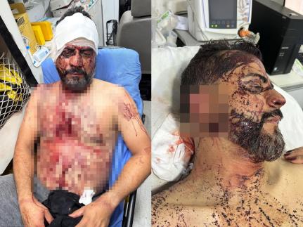 Bandidos queriam R$ 1 milhão, cortam orelha de vereador de MT e ameaçam cortar braço do filho